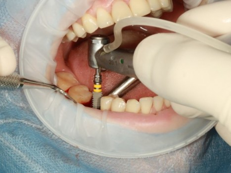 Dentalni implanti: koliko traju, zašto ponekad ne uspeju i kako se rešavaju komplikacije